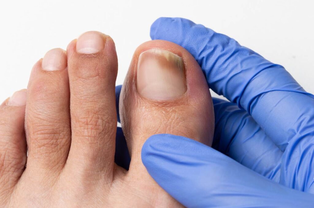 Nagelpilz am Zeh