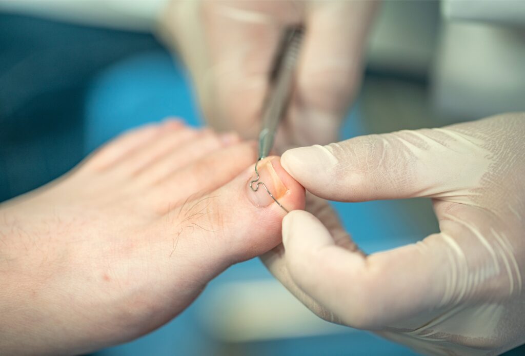 Einsatz Nagelkorrekturspange